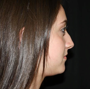 Rhinoplasty Before & After Patient #22313