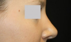 Rhinoplasty Before & After Patient #22357