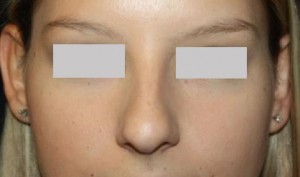 Rhinoplasty Before & After Patient #22357