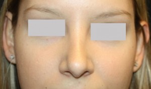 Rhinoplasty Before & After Patient #22357