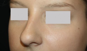Rhinoplasty Before & After Patient #22357