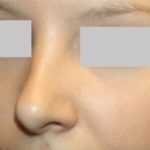 Rhinoplasty Before & After Patient #22357