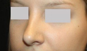 Rhinoplasty Before & After Patient #22357