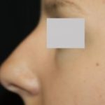 Rhinoplasty Before & After Patient #22357