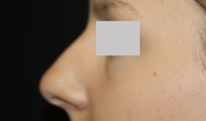 Rhinoplasty Before & After Patient #22357