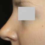 Rhinoplasty Before & After Patient #22357