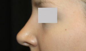 Rhinoplasty Before & After Patient #22357
