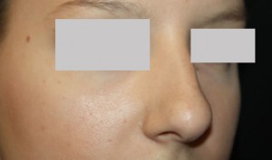 Rhinoplasty Before & After Patient #22357