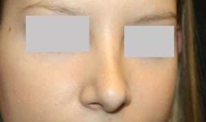 Rhinoplasty Before & After Patient #22357