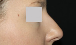 Rhinoplasty Before & After Patient #22357