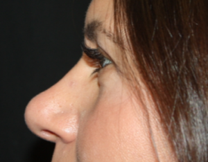 Rhinoplasty Before & After Patient #22379