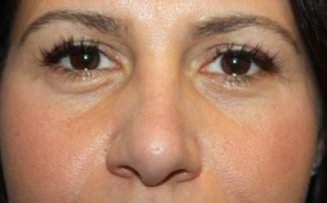 Rhinoplasty Before & After Patient #22379