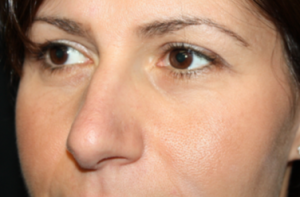 Rhinoplasty Before & After Patient #22379
