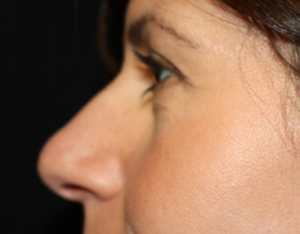 Rhinoplasty Before & After Patient #22379