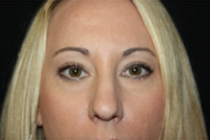 Rhinoplasty Before & After Patient #22413