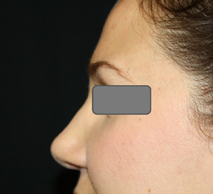 Rhinoplasty Before & After Patient #22434