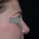Rhinoplasty Before & After Patient #22434