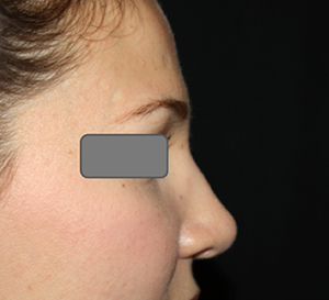 Rhinoplasty Before & After Patient #22434