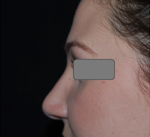 Rhinoplasty Before & After Patient #22434