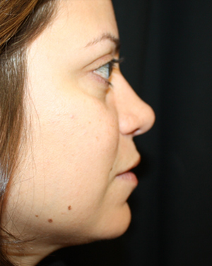 Rhinoplasty Before & After Patient #22446