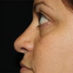 Rhinoplasty Before & After Patient #22446