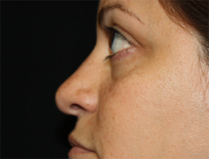 Rhinoplasty Before & After Patient #22446