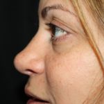 Rhinoplasty Before & After Patient #22446