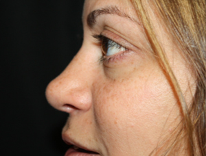 Rhinoplasty Before & After Patient #22446