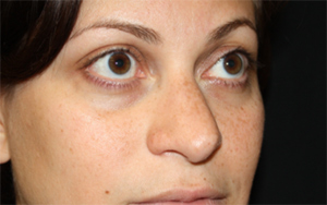 Rhinoplasty Before & After Patient #22446