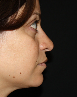 Rhinoplasty Before & After Patient #22446