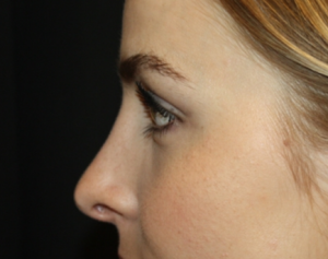 Rhinoplasty Before & After Patient #22468