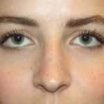 Rhinoplasty Before & After Patient #22468