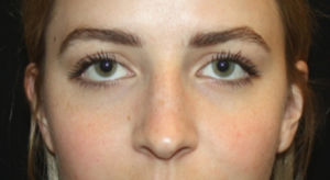 Rhinoplasty Before & After Patient #22468