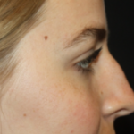 Rhinoplasty Before & After Patient #22468