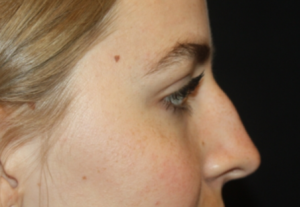 Rhinoplasty Before & After Patient #22468