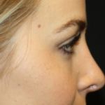 Rhinoplasty Before & After Patient #22468