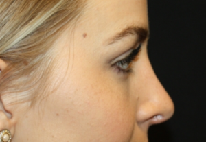 Rhinoplasty Before & After Patient #22468