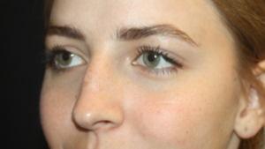 Rhinoplasty Before & After Patient #22468