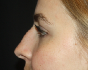 Rhinoplasty Before & After Patient #22468