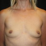 Breast Augmentation - Round Silicone Implants Before & After Patient #20366