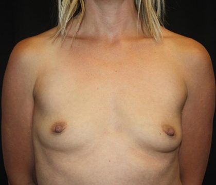 Breast Augmentation - Round Silicone Implants Before & After Patient #20366