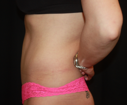 Tummy Tuck Before & After Patient #22356