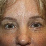 Blepharoplasty Before & After Patient #20131