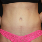 Tummy Tuck Before & After Patient #22356