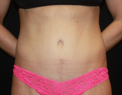 Tummy Tuck Before & After Patient #22356