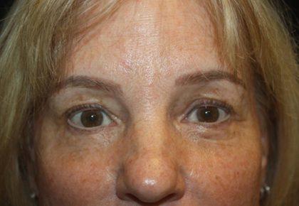 Blepharoplasty Before & After Patient #20131