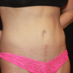 Tummy Tuck Before & After Patient #22356