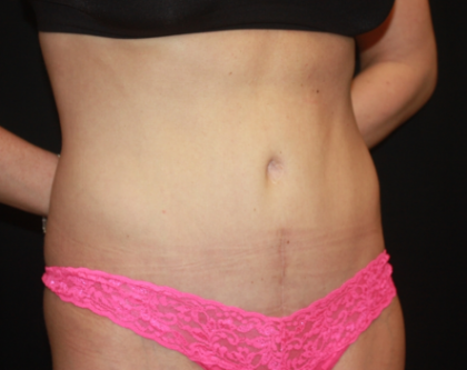 Tummy Tuck Before & After Patient #22356