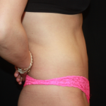 Tummy Tuck Before & After Patient #22356