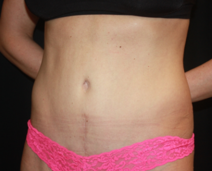 Tummy Tuck Before & After Patient #22356